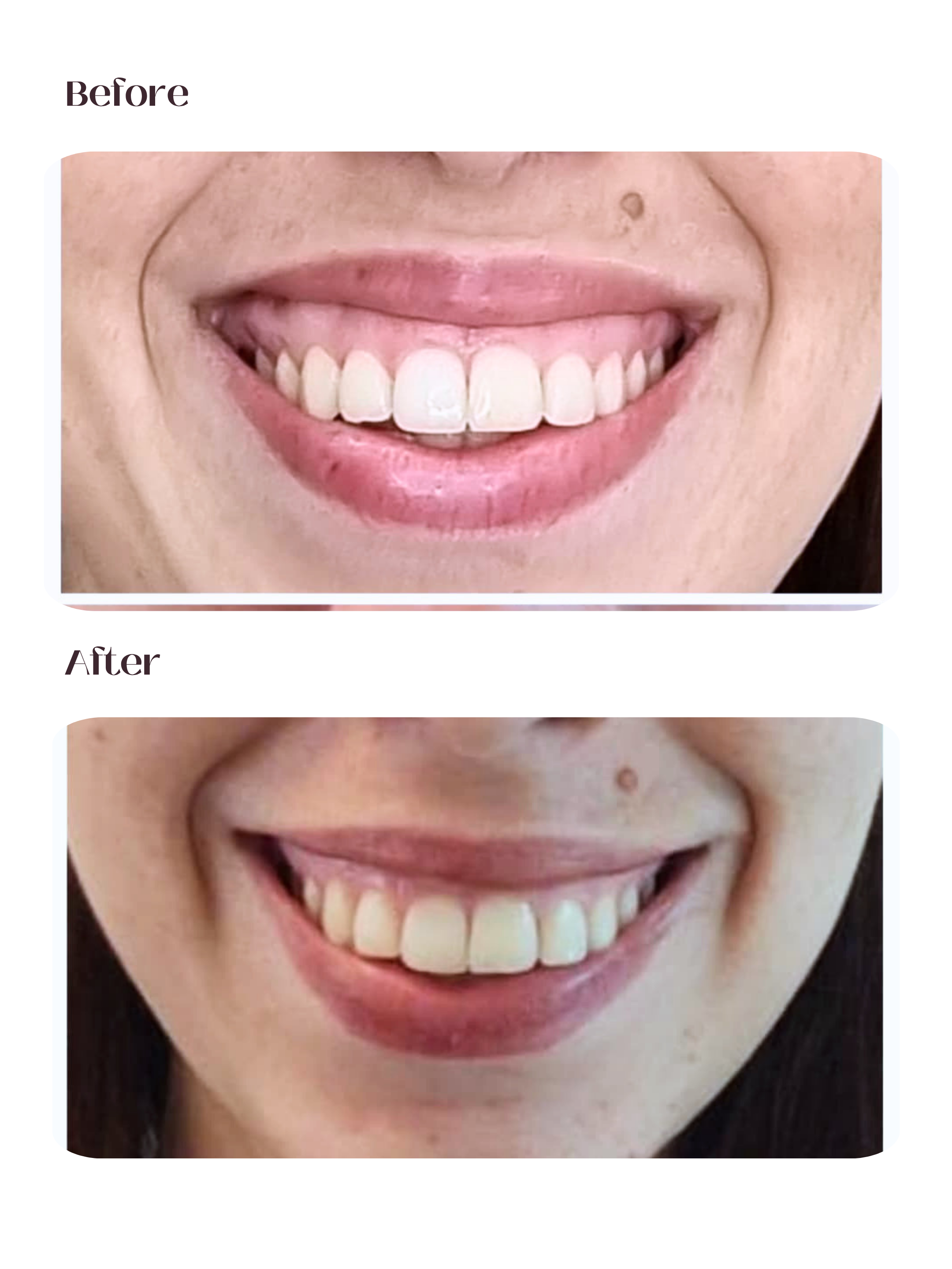 Sorriso Gengival