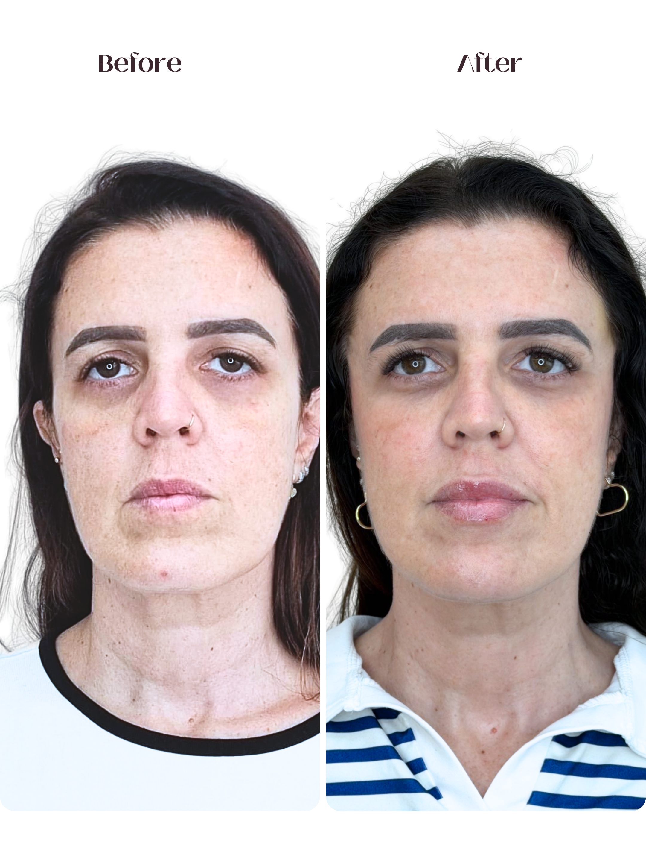 Fios de Sustentação