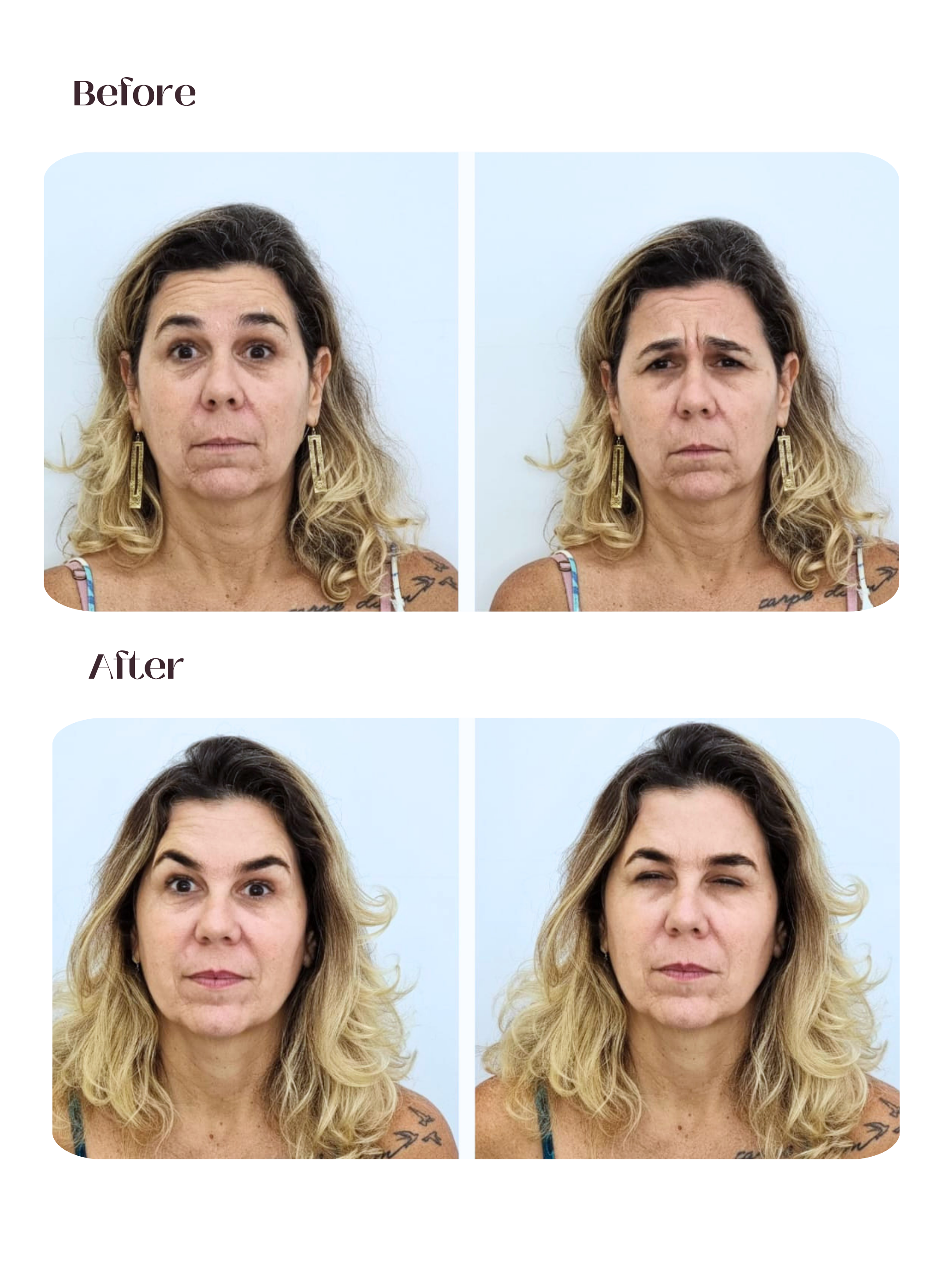 Rejuvenescimento Facial